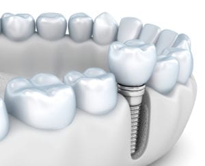 Affordable dental Implants in Bountiful Utah at Larsen Family Dental