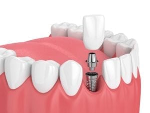 affordable dental implants in bountiful, utah