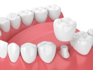 restore your smile with dental crowns Bountiful Utah