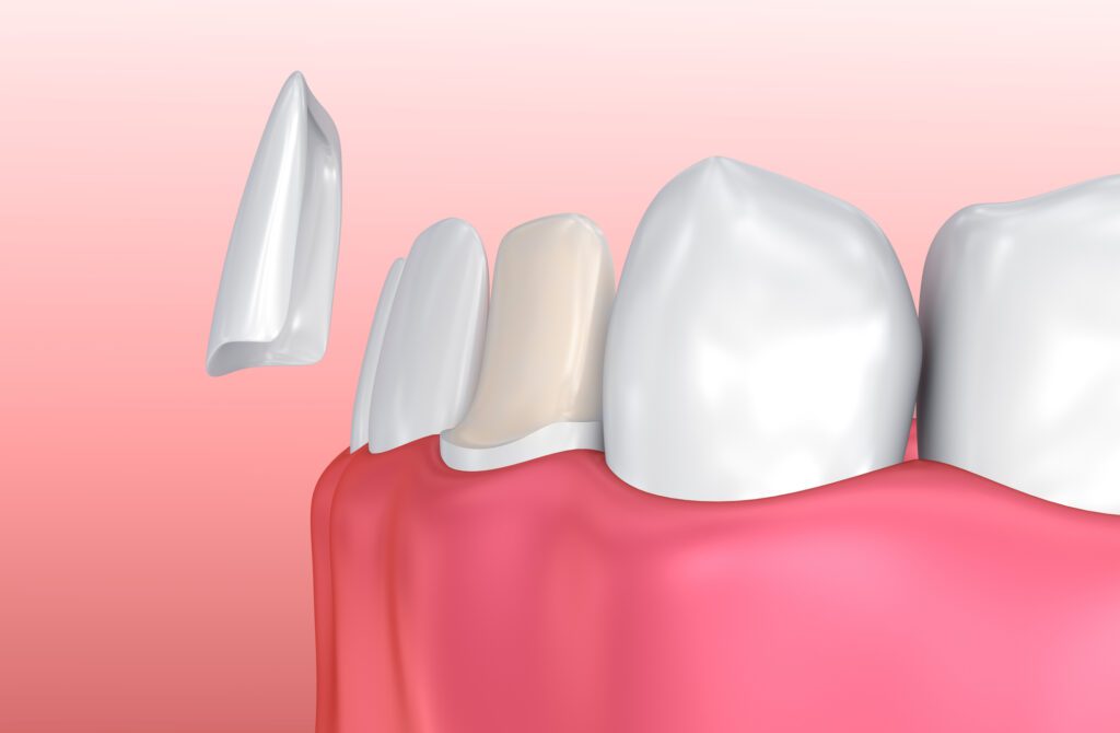 Porcelain veneers in Bountiful, UT, could help cover up minor imperfections in your teeth from slight discoloration to misshapen teeth.
