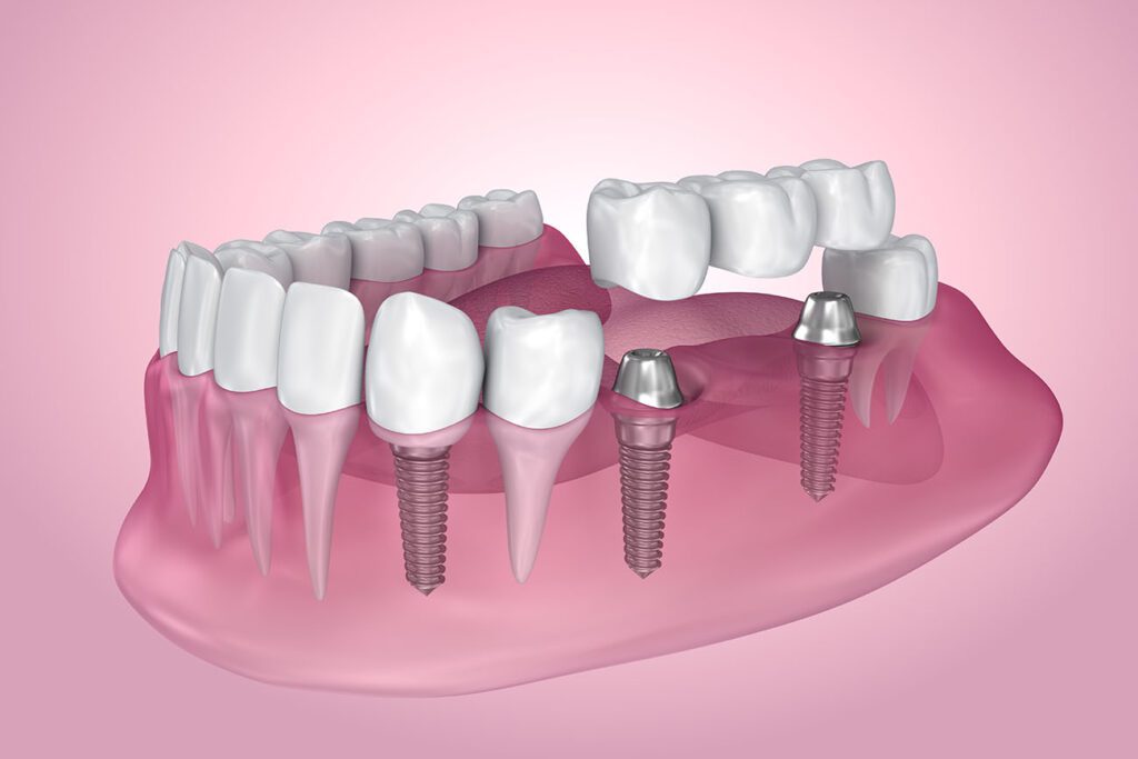 DENTAL IMPLANTS in BOUNTIFUL UT need a restoration to fully complete your smile